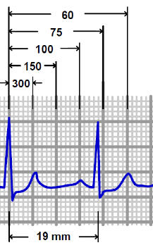  misurazioni ecg Azzolini pier lorenzo medico dello sport Carpi tachicardia